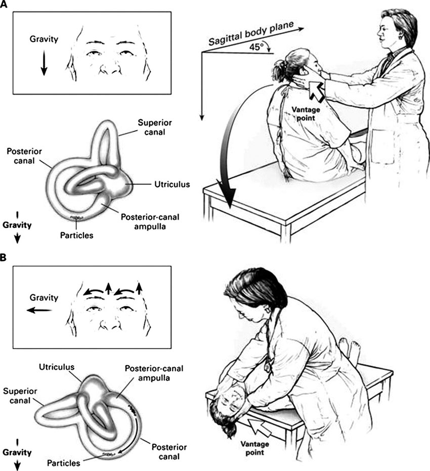 Figure 2 - The Hallpike-Dix Manoeuvre A commonly used test to assess BPPV. 