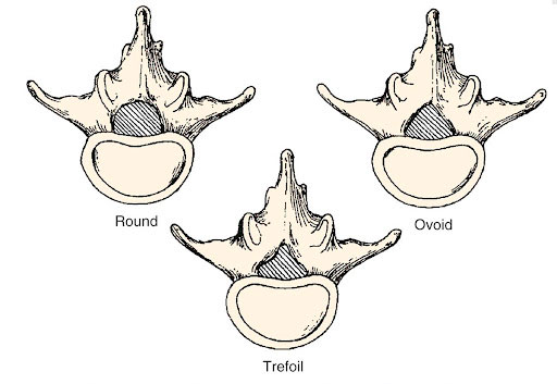 Figure 2 – Different Shapes of Central Spinal Canal 