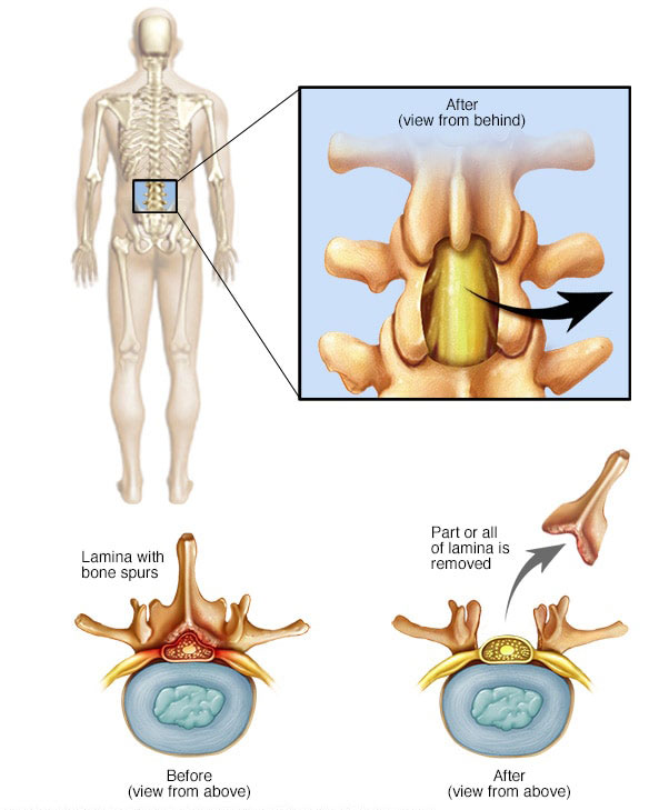 Figure 6 – Visual Representation of a Lumbar Laminectomy Procedure