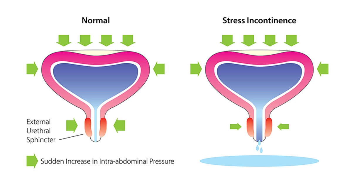 Incontinence in the Female Athlete