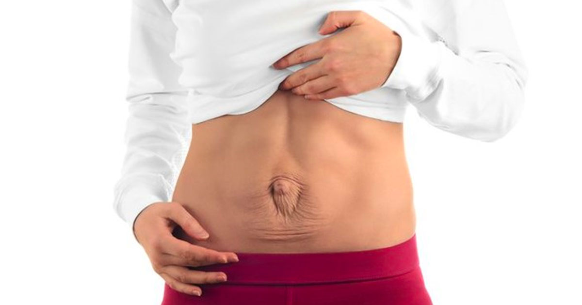 Abdominal Separation in the Pre and Postnatal period