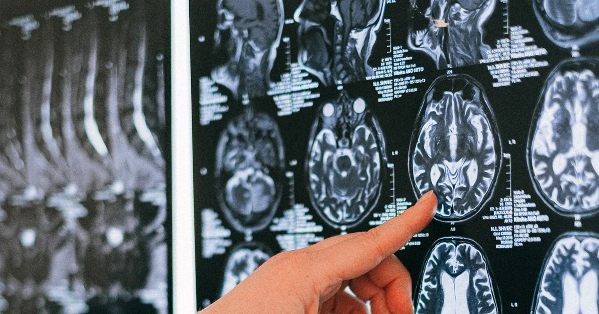 Exercise physiology after stroke is structured, progressive exercise prescribed by an Accredited Exercise Physiologist to help you rebuild strength, balance, walking and fitness once your condition is stable. 