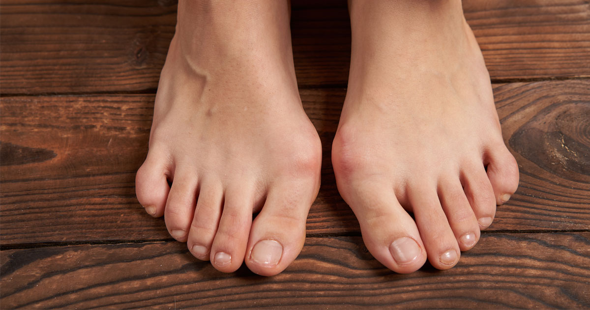 If you notice a bump forming at the base of your big toe, pushing it sideways, you might have a bunion, medically known as hallux valgus. 