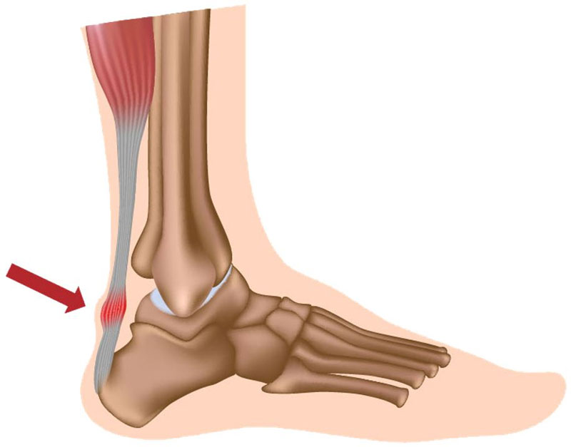 Achilles Tendinopathy