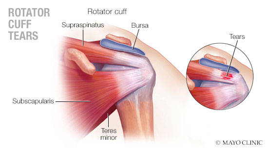 Rotator cuff tears