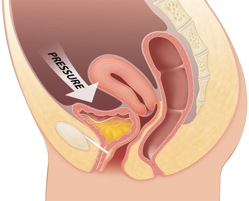 Stress Incontinence