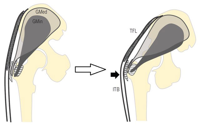 Tendon fibres rubbing over bone