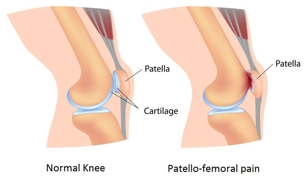 Diagram of a normal knee vs a knee with patello-femoral pain