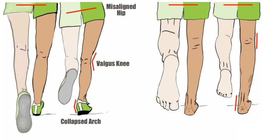 Misaligned hip, valgus knee, collapsed arch