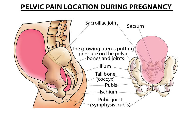 Pelvic pain location during pregnancy