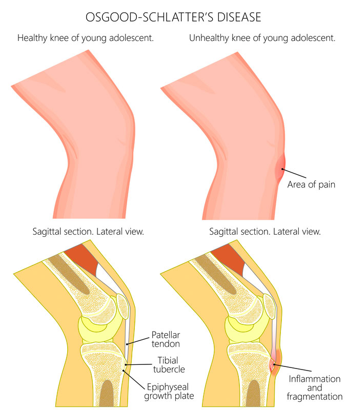 Healthy Knee vs a knee with Osgood-Schlatter's Disease