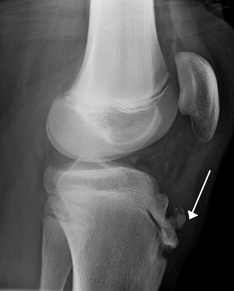 Repeated micotrauma irritates the front of the shin bone.