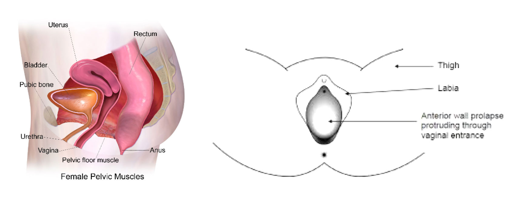 What happens in prolapse