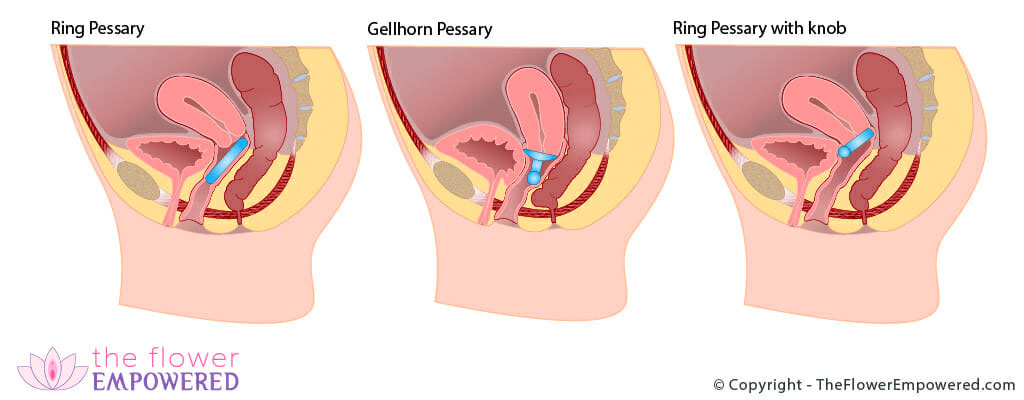 Pessaries can be used to treat pelvic organ prolapse