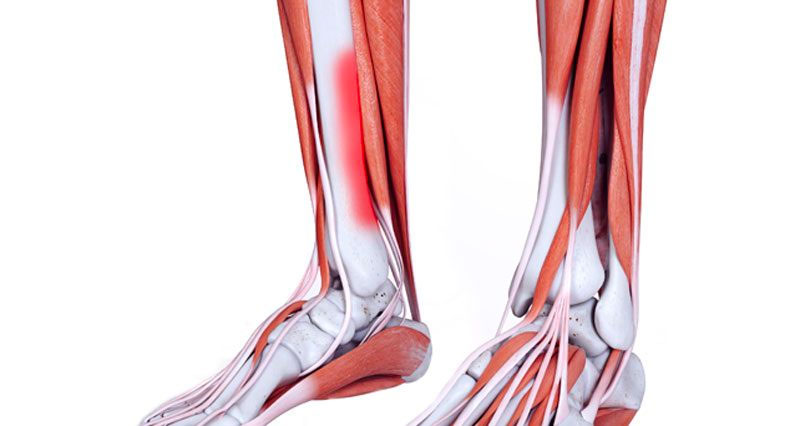 Shim splints causes pain and tenderness along the lower portion of the shin bone.