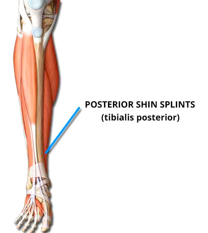 Posterior Shin Splints (Tibialis Posterior)