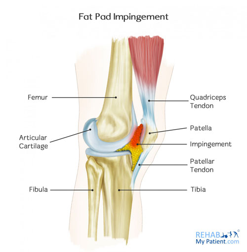 Fat pad impingement