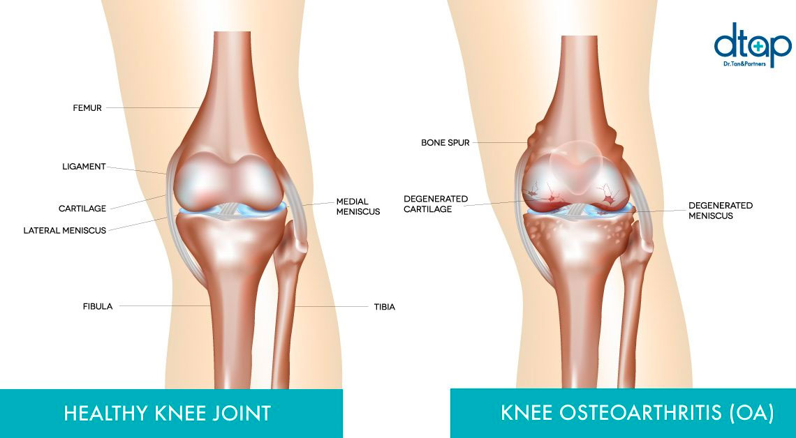 Healthy knee joint vs joint with ostearthritis