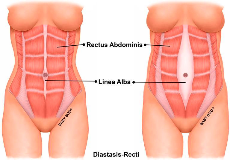 Diagram of Diastasis Recti