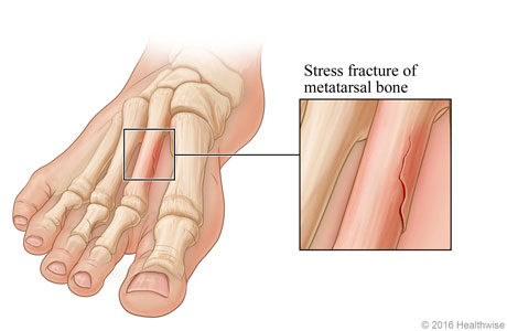 Stress fracture of metatarsal bone