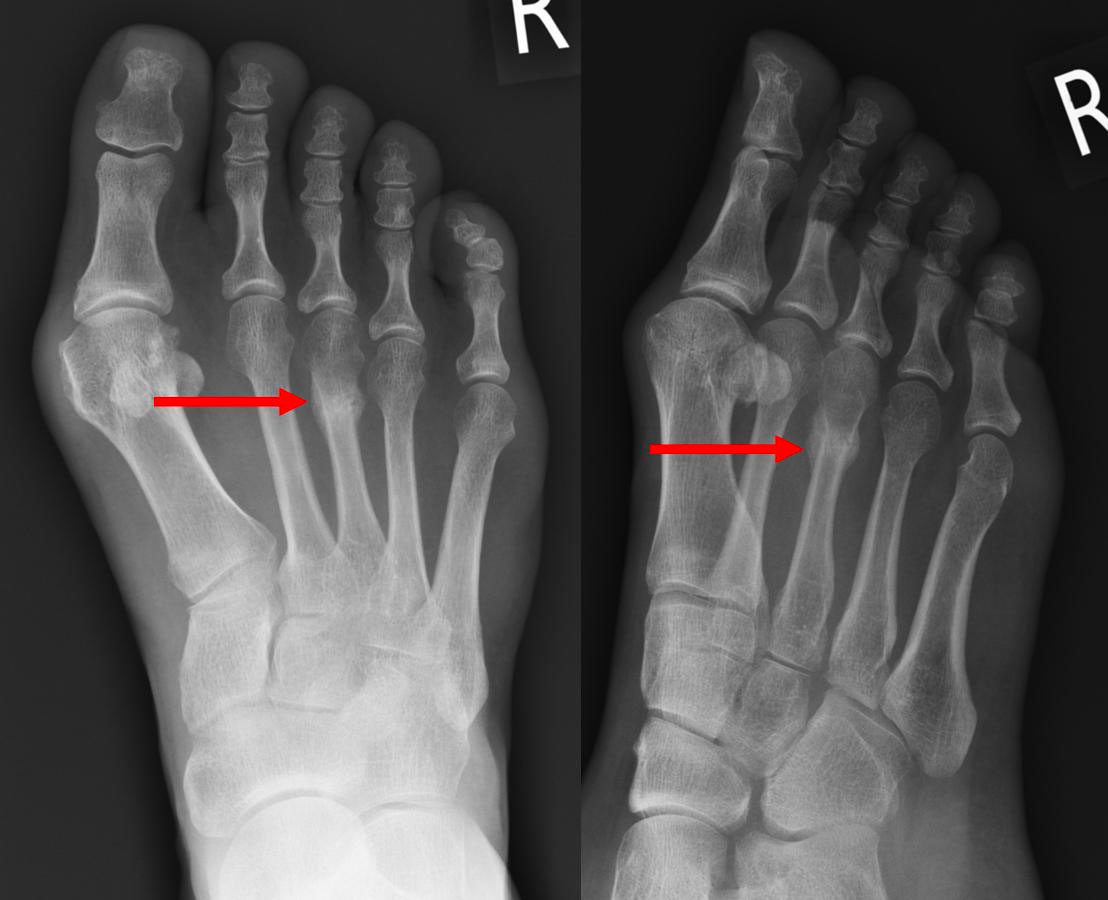 Right foot xray showing stress fracture