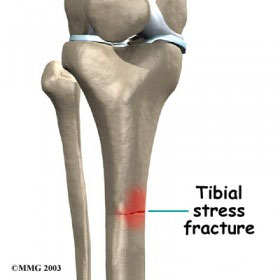 Tibial stress fracture