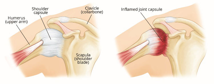 Anatomy of an inflamed shoulder joint capsule