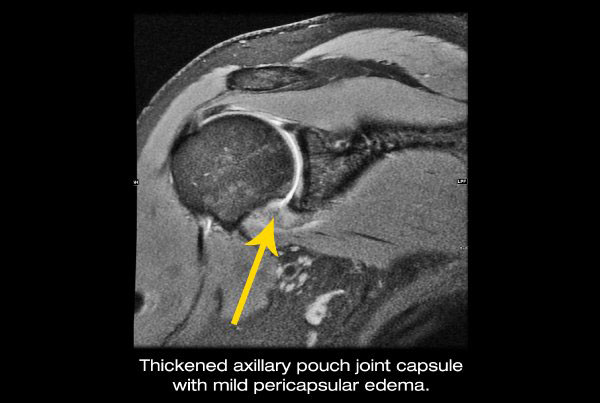 Ultrasound showing joint capsule oedema of the shoulder
