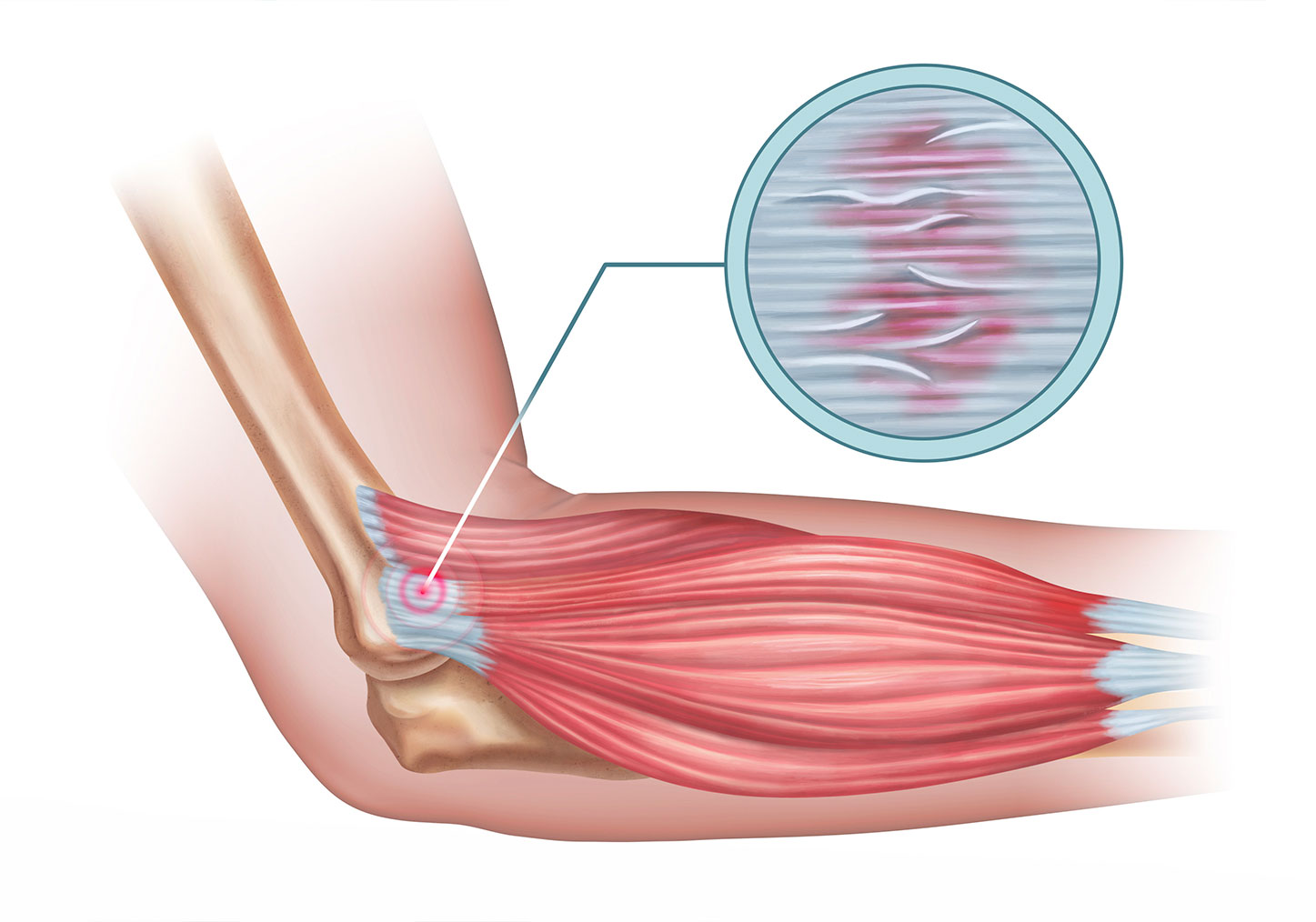 Diagram showing lateral epicondylitis or tennis elbow