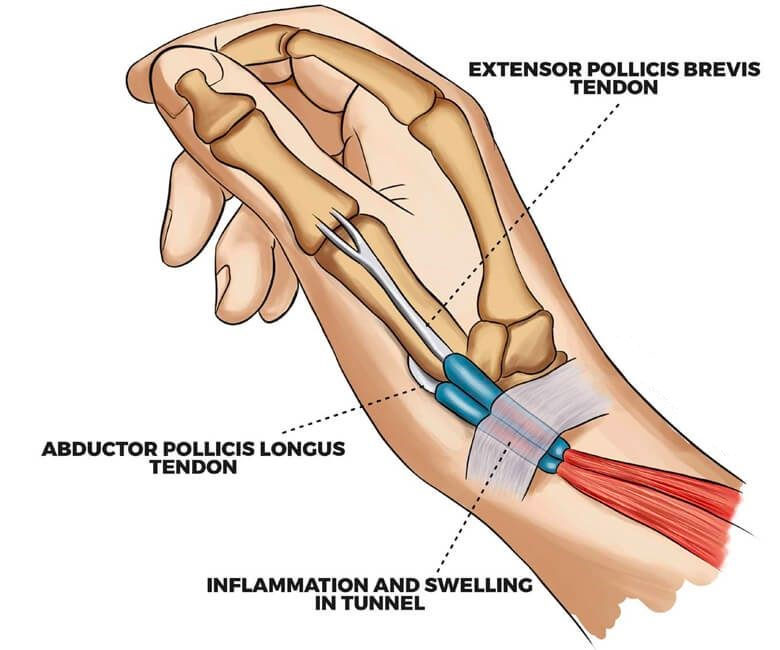 Diagram showing the tendons of the thumb