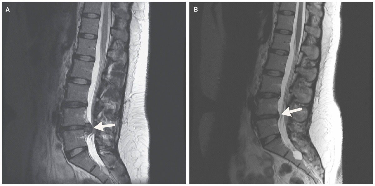 MRI findings without symptoms or pain have very little meaning.