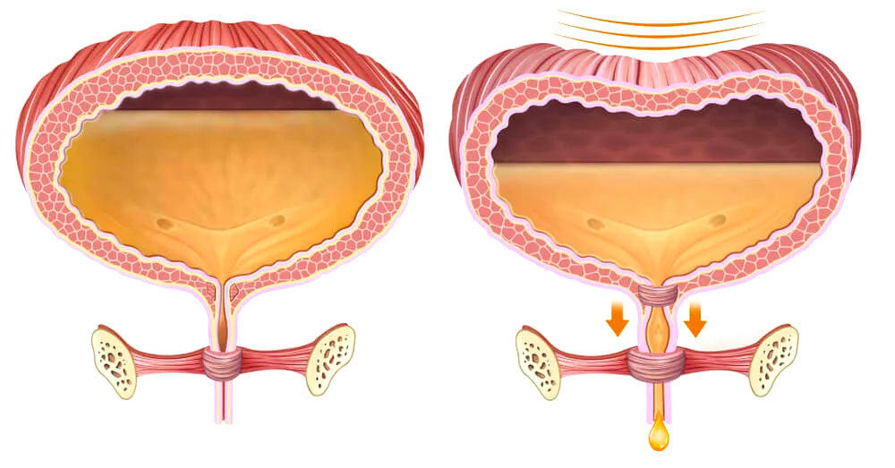 Diagrams showing the bladder and pelvic floor in action