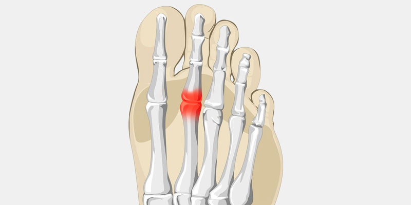 Diagram highlighting the 2nd metatarsal bone