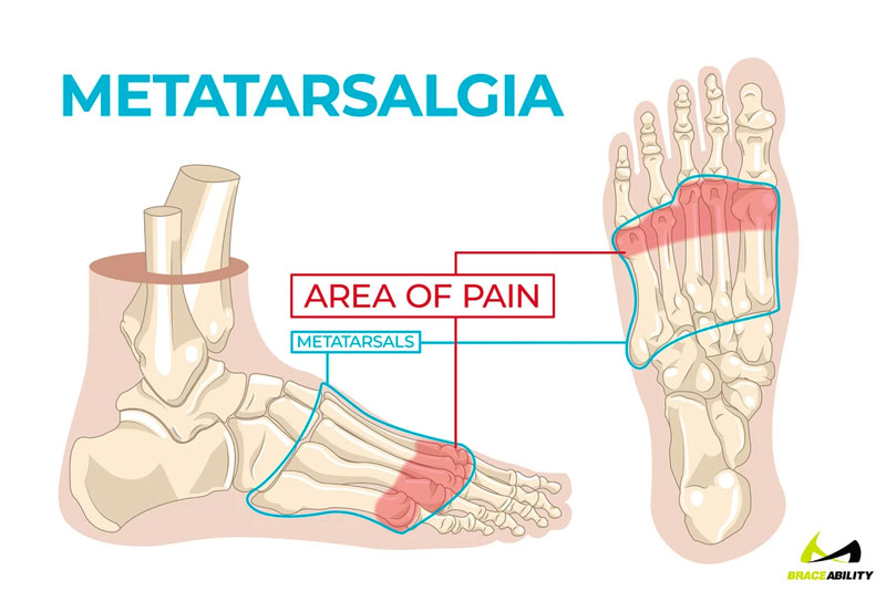 Diagram showing the area of pain in metatarsalgia