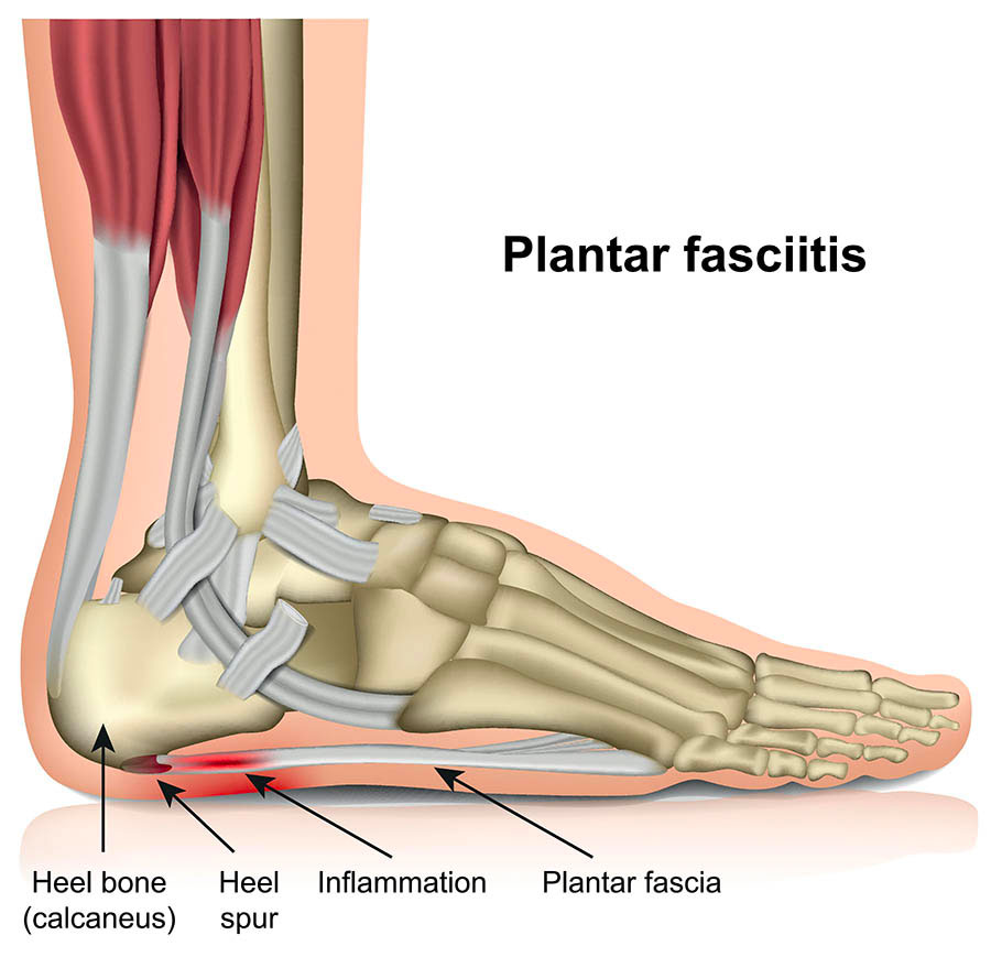 Diagram showing location of plantar fasciitis