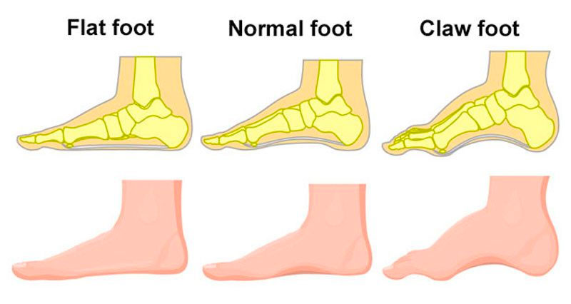 Diagram showing flat foot vs normal foot vs claw foot