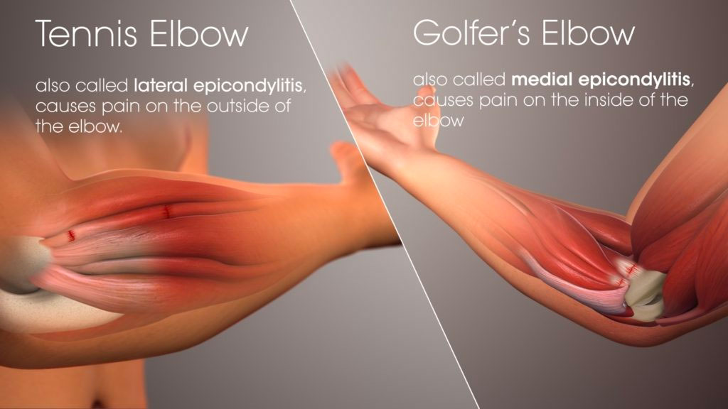 Diagram of tennis elbow vs golfers elbow