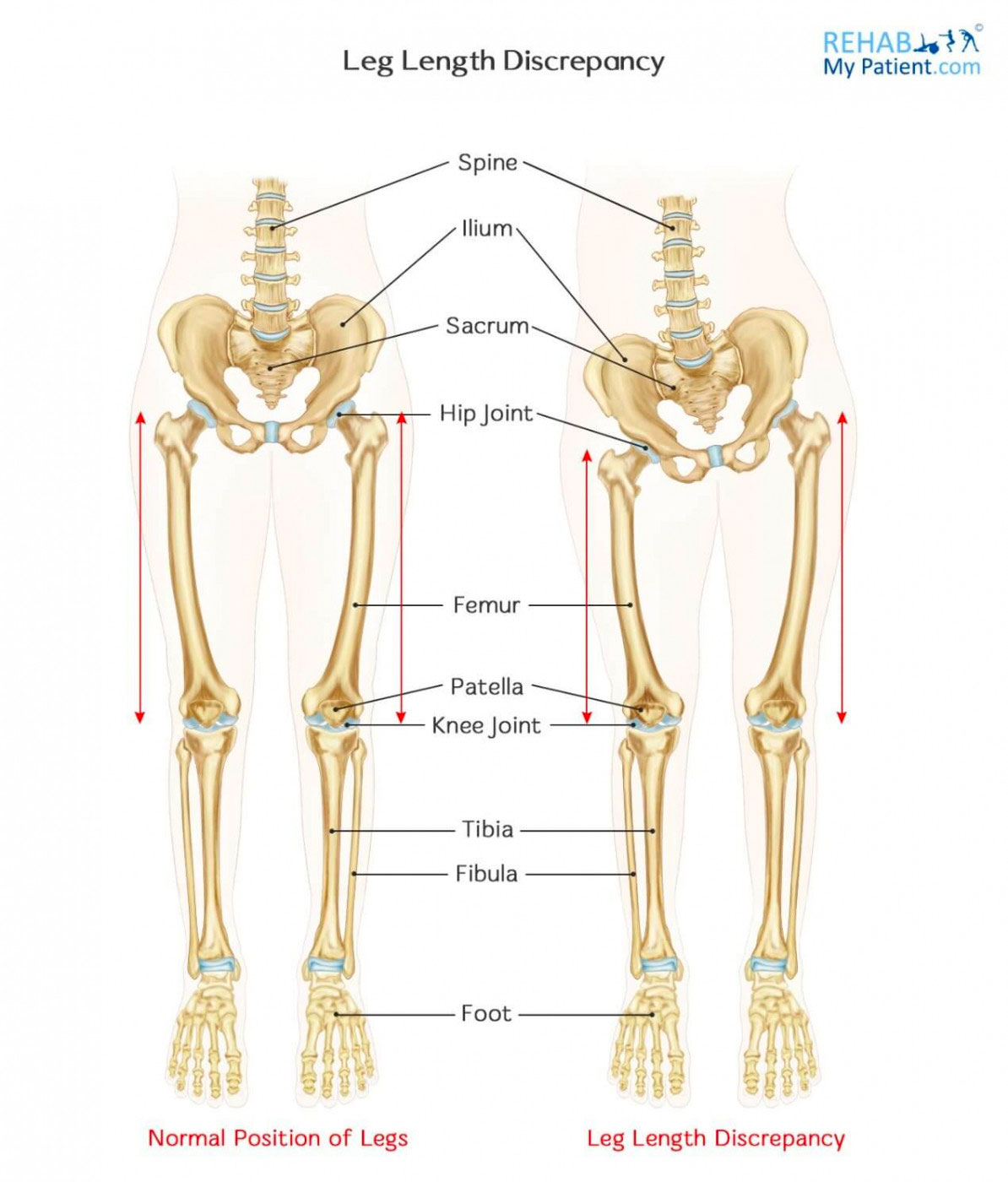 Diagram of normal position of legs vs leg length discrepancy