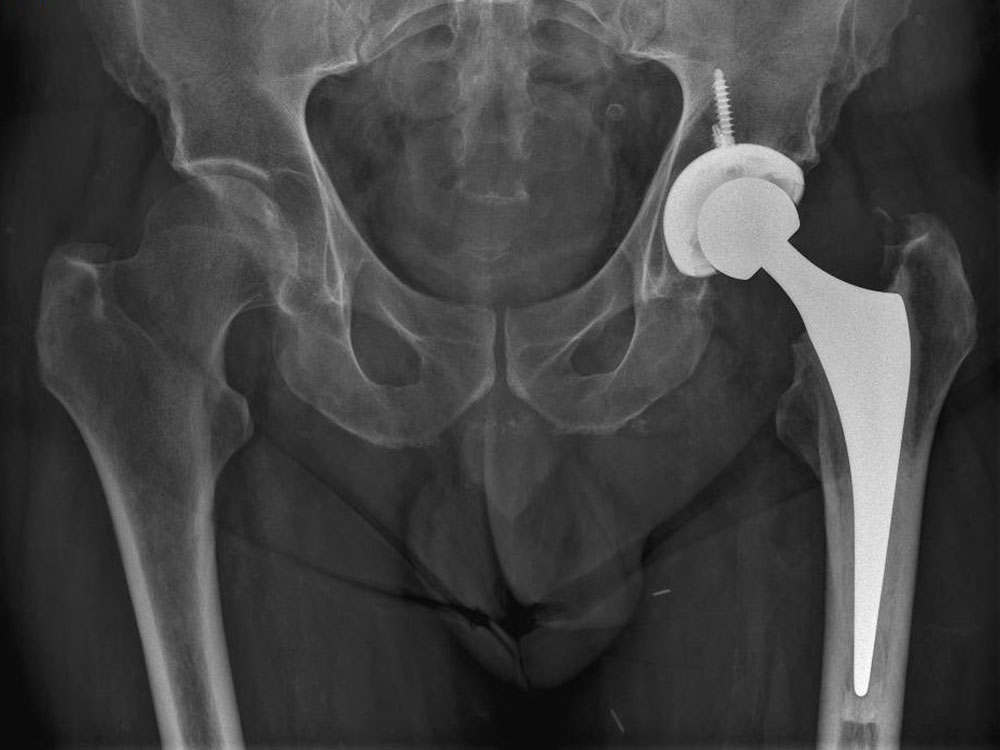 Xray of hips with hip replacement