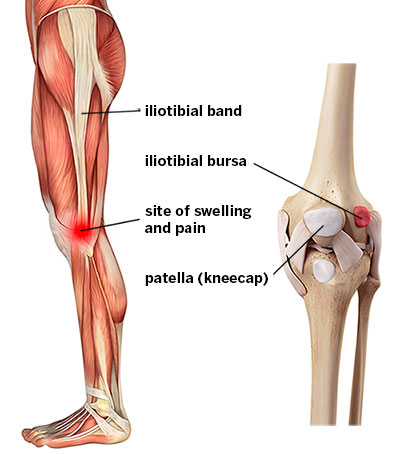 Diagram showing site of pain in iliotibial band syndrome