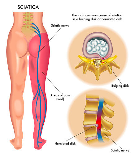 In the case of an inter-vertebral disc protrusion, there is potential that the disc can extend back and impinge on the nerves that supply the lower limbs.