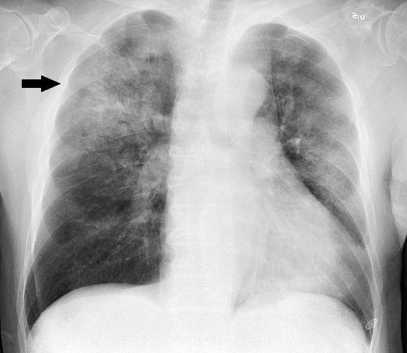 X-rays are used to rule out serious causes of chest pain