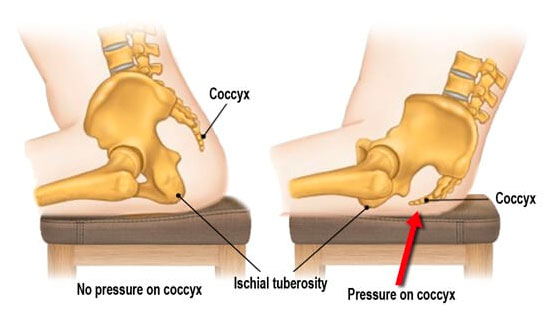 Diagram showing pressure on the coccyx