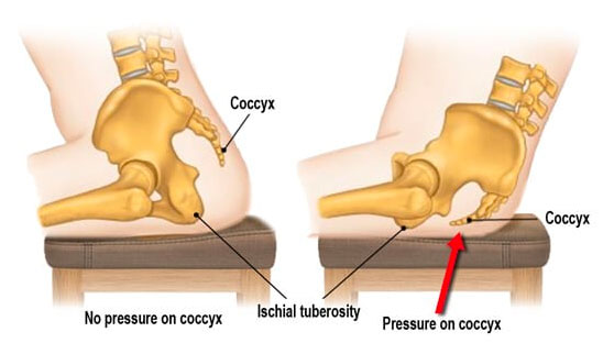 Coccydynia (AKA Tailbone Pain): What Causes it? How Do I Get better?