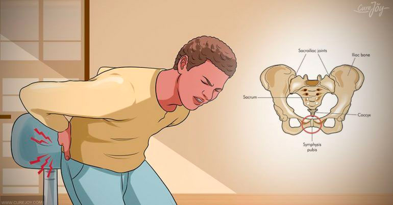Coccydynia is also known as tailbone pain