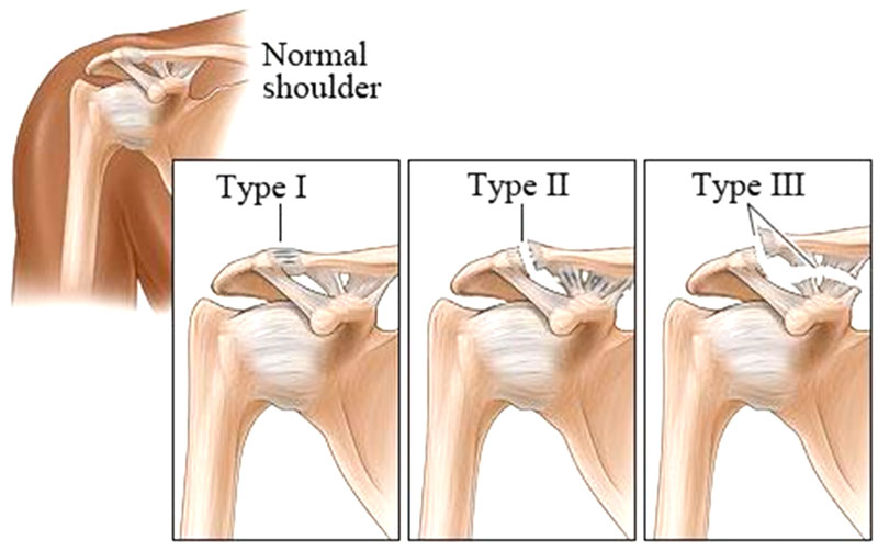 A Simple Visual Representation of Different Grades of AC Joint Injury 