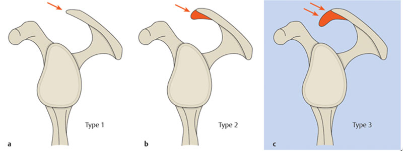 A Visual representation of different acromion types.  