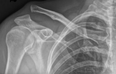 X-Ray Right Shoulder - A Grade 3 AC Joint Injury. 