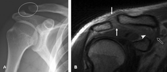 X-ray (left) and MRI (right) of a Grade 2 AC Joint Injury of the Right Shoulder.