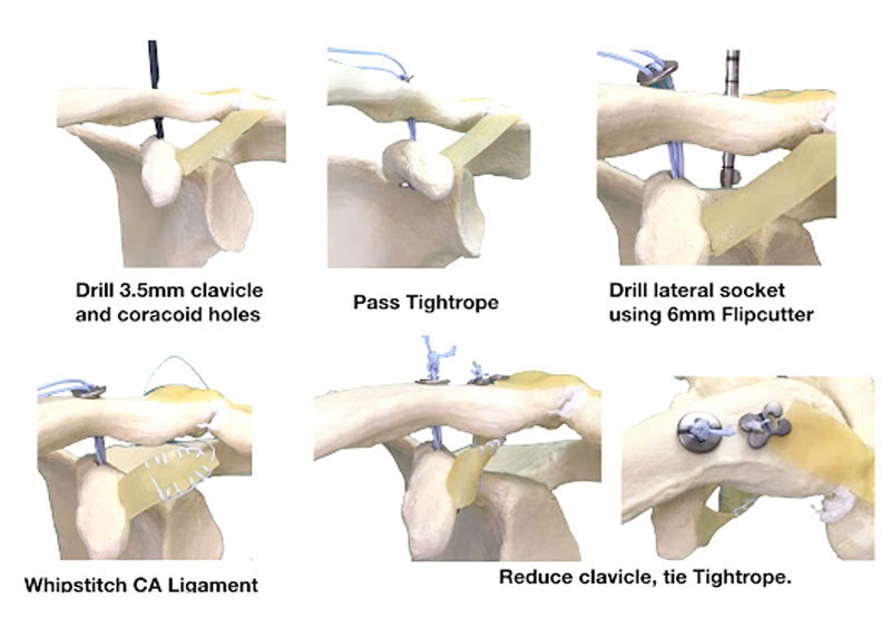 Diagram of Tightrope Procedure – A common surgery for severe AC Joint Injury